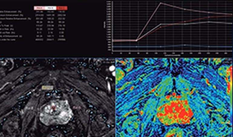 Próstata multiparamétrica (no invasivo)