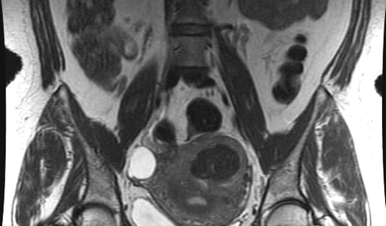 Resonancia de abdomen y pelvis